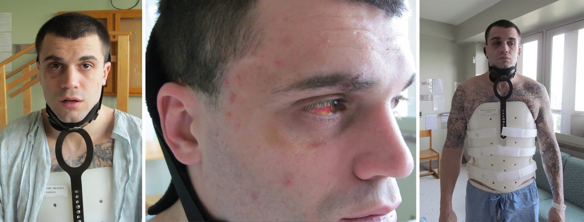 Andrew Nascarella suffered a fractured back, broken nose and required 15 stitches after an incident with Essex County jail corrections officers. (Courtesy Prisoner’s Legal Services)