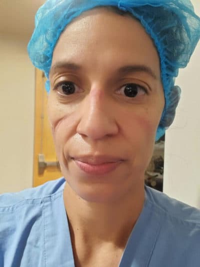 Celia Nieto is a ICU nurse at St. Rose Dominican Siena Campus in Henderson, Nevada. This is a photo of her after wearing a N95 face mask for 12 hours on shift. (Courtesy) 