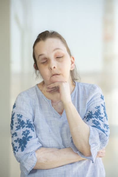 Carmen Blandin Tarleton following her second face transplant led by Dr. Pomahac at Brigham and Women's Hospital. (Len Rubenstein Photography)