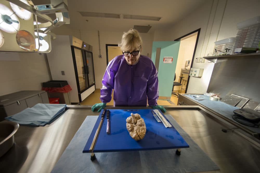 Dr. Ann C. McKee, director of Boston University's CTE Center and Chief of Neuropathology at the VA Boston Healthcare System, does an autopsy on the brain of an NFL player who died in his 40s and donated his brain to to the VA-BU-CLF Brain Bank in Jamaica Plain on July 12, 2017. (Stan Grossfeld/The Boston Globe via Getty Images)