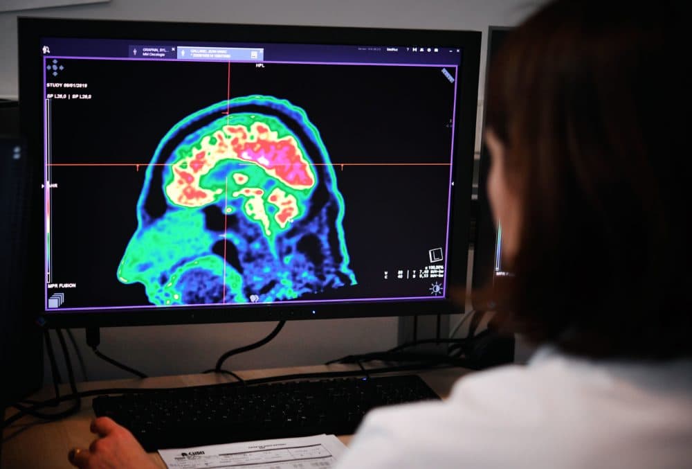 A picture of a human brain taken by a positron emission tomography scanner, also called PET scan, is seen on a screen. (Fred Tanneau/AFP via Getty Images)