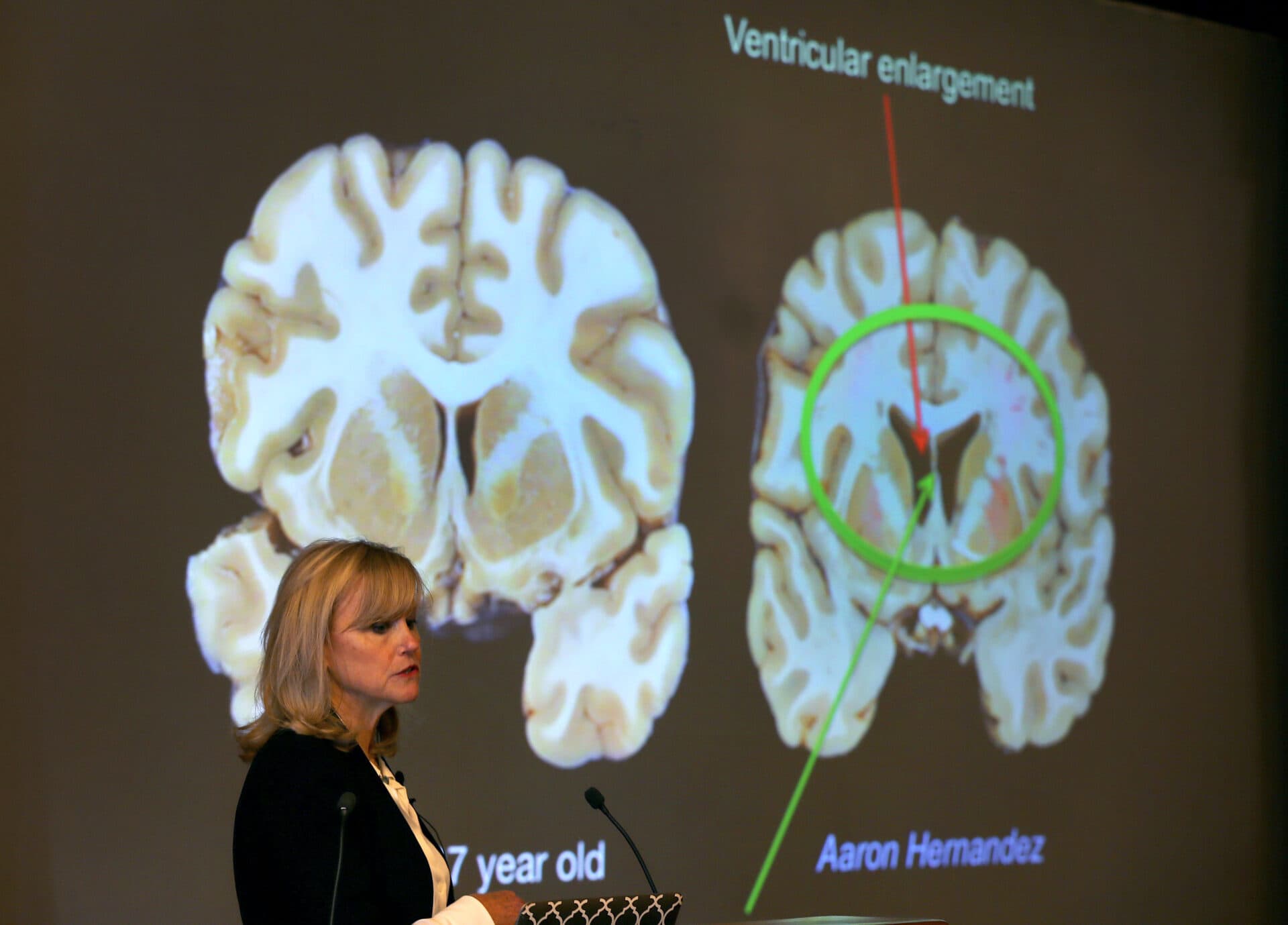 In this 2017 file photo, Dr. Ann McKee announced her findings on her examination of the brain of Aaron Hernandez at Boston University. She shows Hernadez's brain, right, compared to a normal 27-year-old's brain. (John Tlumacki/Boston Globe)