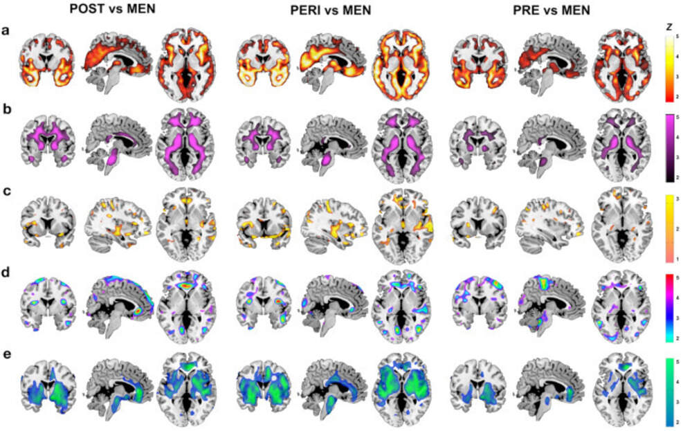 MRI slice overlays displaying biomarker differences between each MT group and males. (Credit: "Menopause impacts human brain structure, connectivity, energy metabolism, and amyloid-beta deposition" /Sci Rep. 2021)