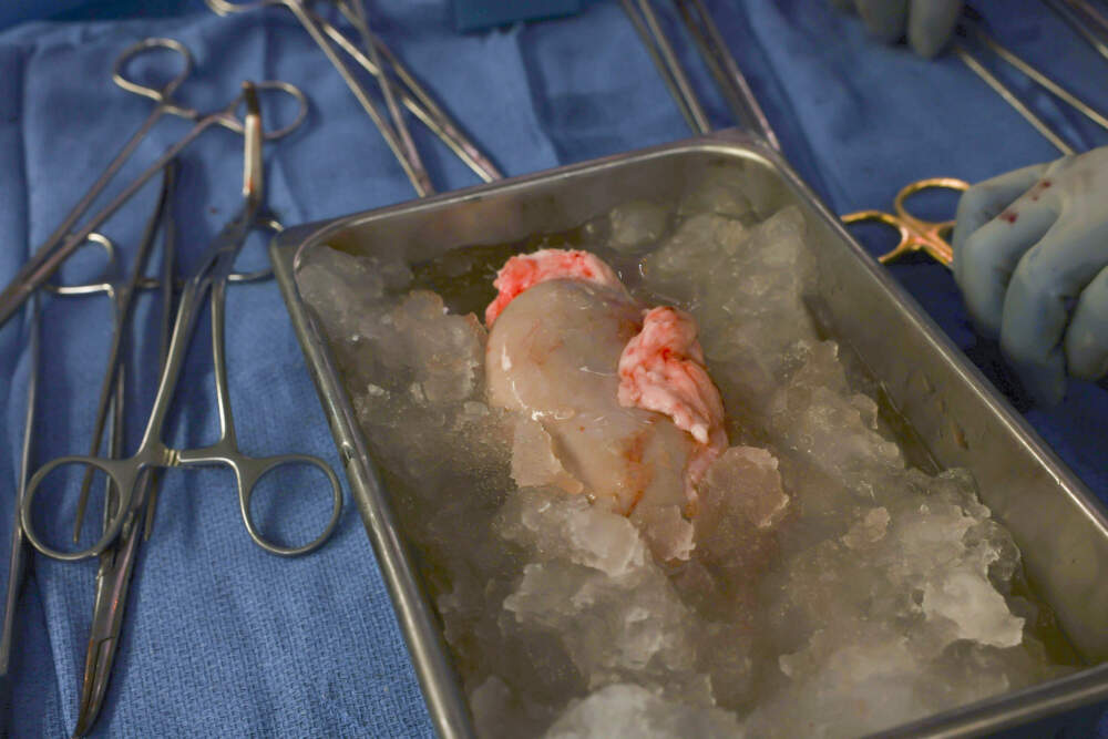 The genetically modified pig kidney during surgery. (Courtesy Massachusetts General Hospital)
