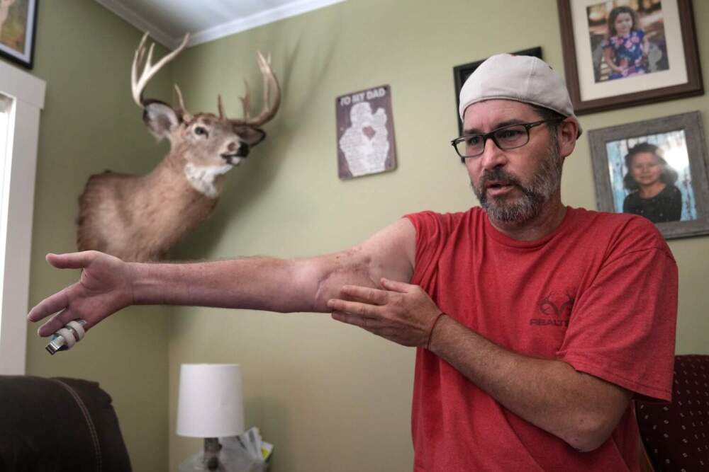 Ben Dyer talks about the injuries he suffered during the October 2023 mass shooting at Schemengee's Bar and Grille in Lewiston, Maine, at his home in Auburn, Maine, Thursday, June 6, 2024. Dyer, a lifelong hunter, survived being hit by several bullets, including one that shot off his right index finger. (Robert F. Bukaty/AP)