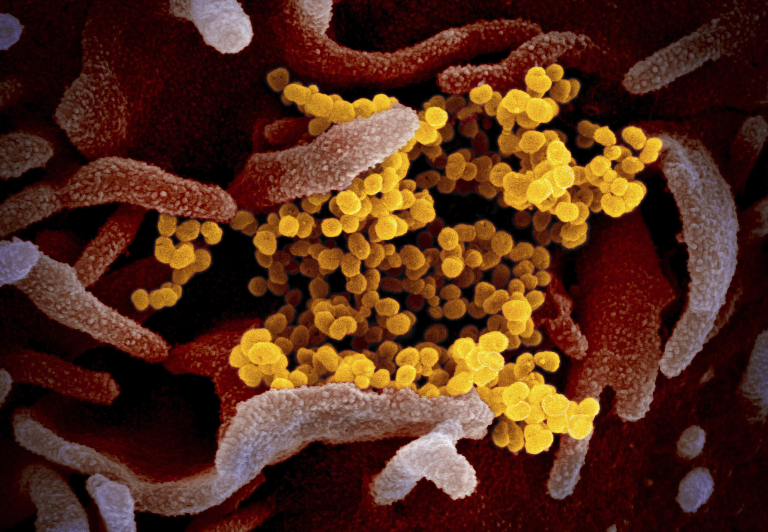 This undated electron microscope image made available by the U.S. National Institutes of Health in February 2020 shows the Novel Coronavirus SARS-CoV-2, yellow, emerging from the surface of cells, pink, cultured in the lab. Also known as 2019-nCoV, the virus causes COVID-19. The sample was isolated from a patient in the U.S. (NIAID-RML via AP)