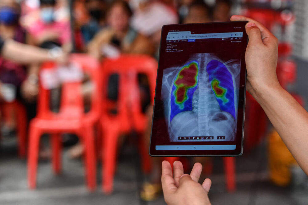 In this photo, taken on March 14, 2024, a medical worker shows an x-ray during a tuberculosis screening at a health center in Valenzuela, a city in the Philippines. (JAM STA ROSA/AFP via Getty Images)
