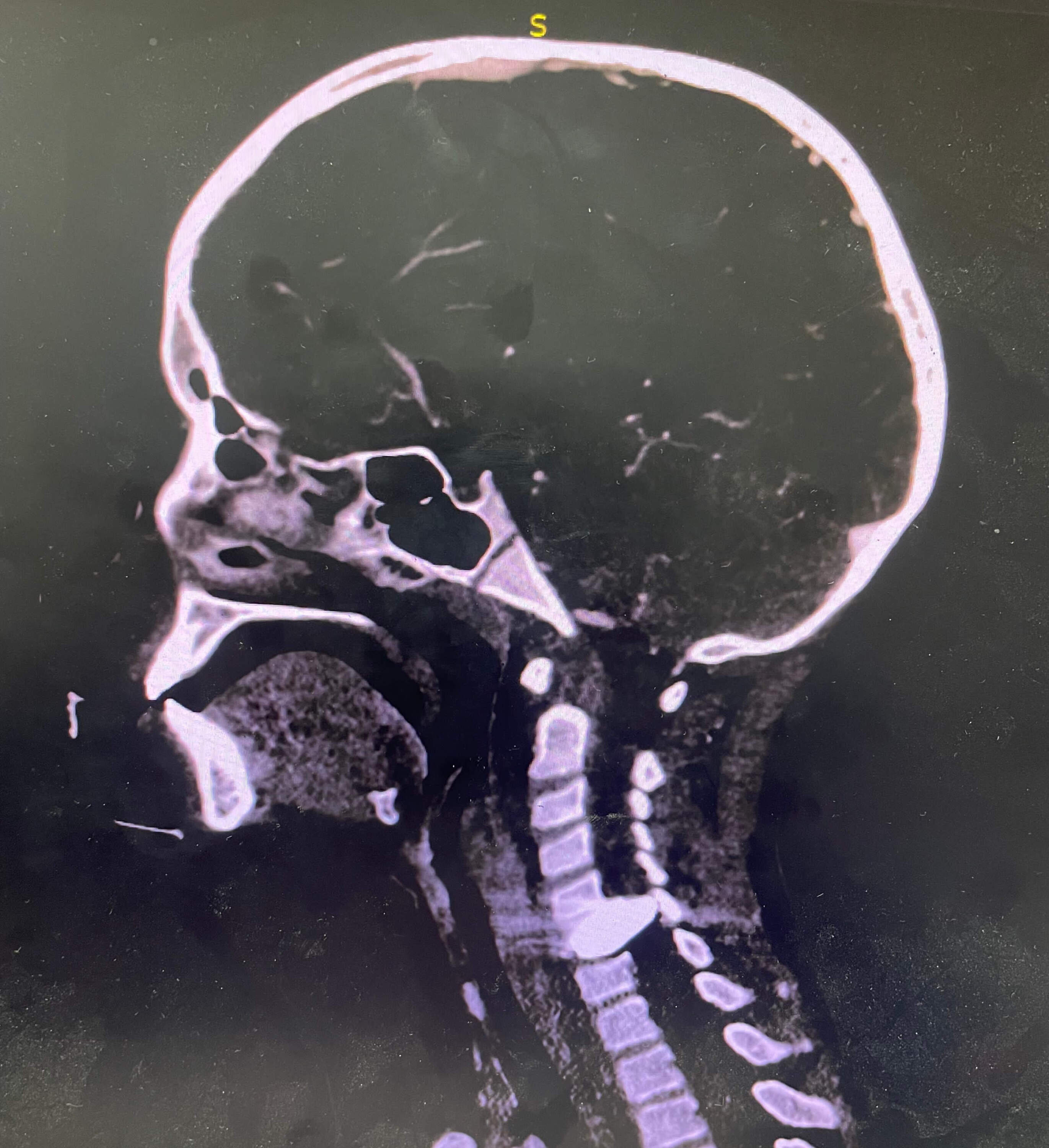 An x-ray photo of a young boy with a bullet lodged in his neck. (Courtesy of Dr. Adil Husain)