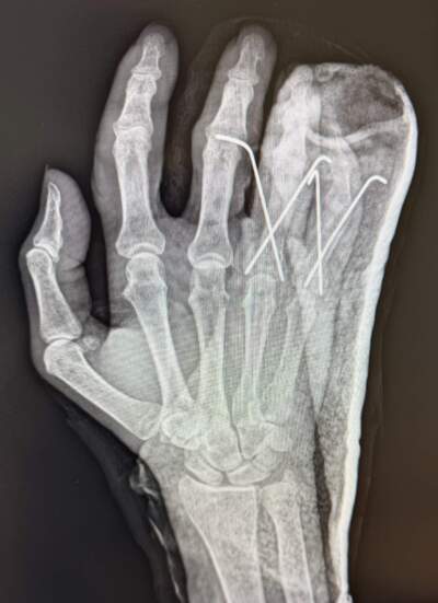 An x-ray of the author's right hand, showing two broken finger and a dislocated finger, after she fell on the tennis court. (Courtesy Kathy Gunst)