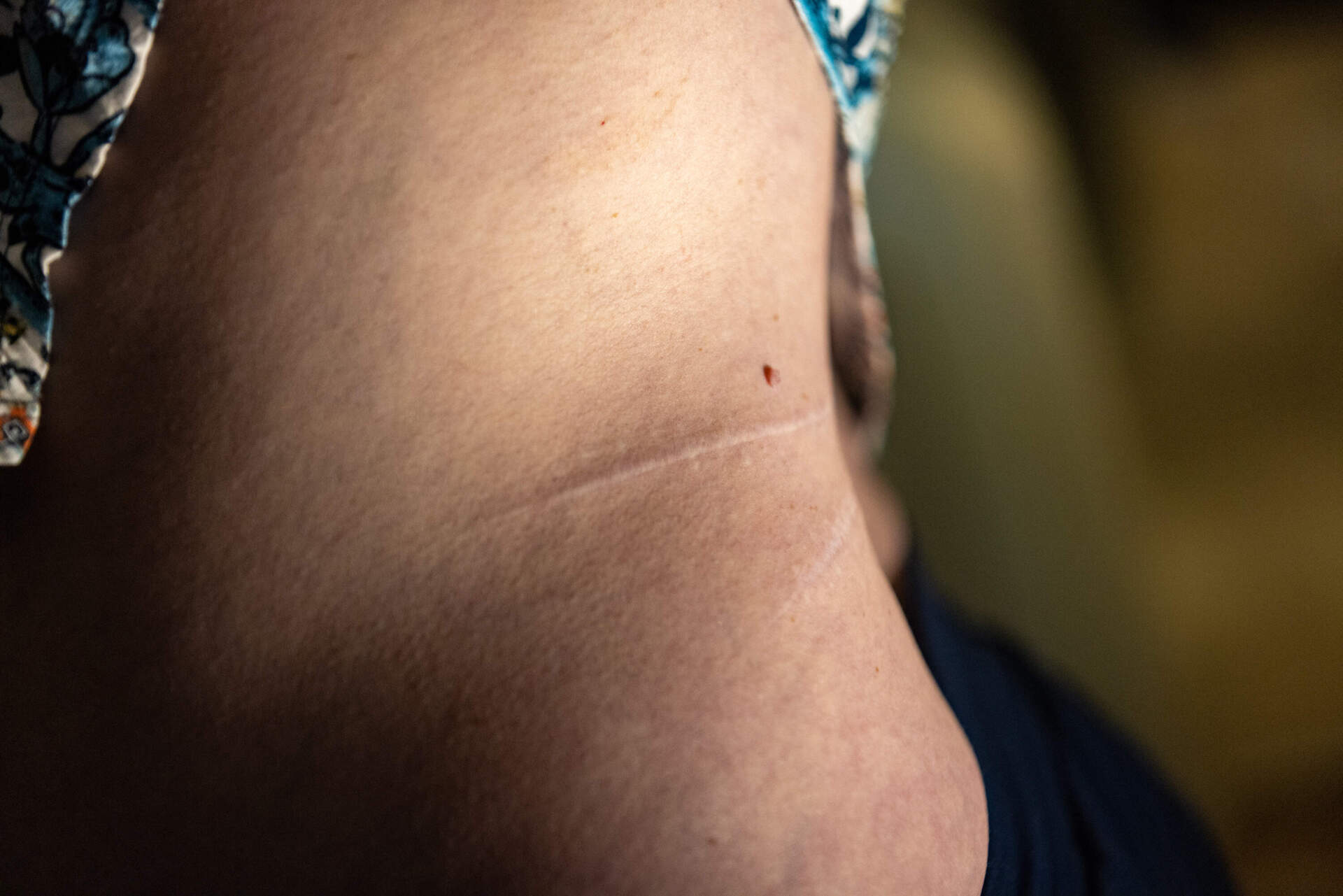 Louise presentations her scars from two decades ago when a man raped and stabbed her. (Jesse Costa/WBUR)