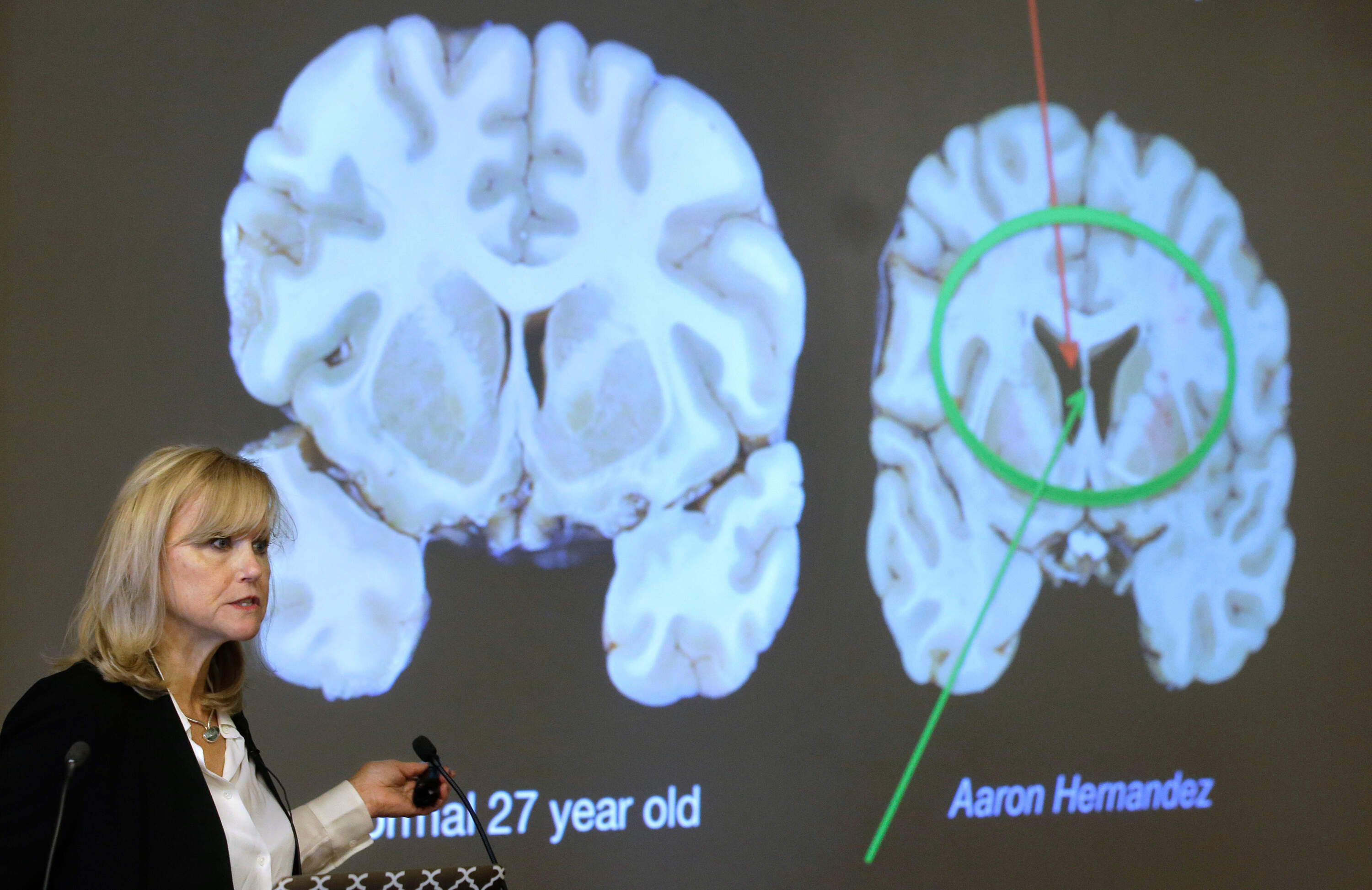 A researcher presents the study of NFL football player Aaron Hernandez's brain, projected on a screen, behind right. (Steven Senne/AP)