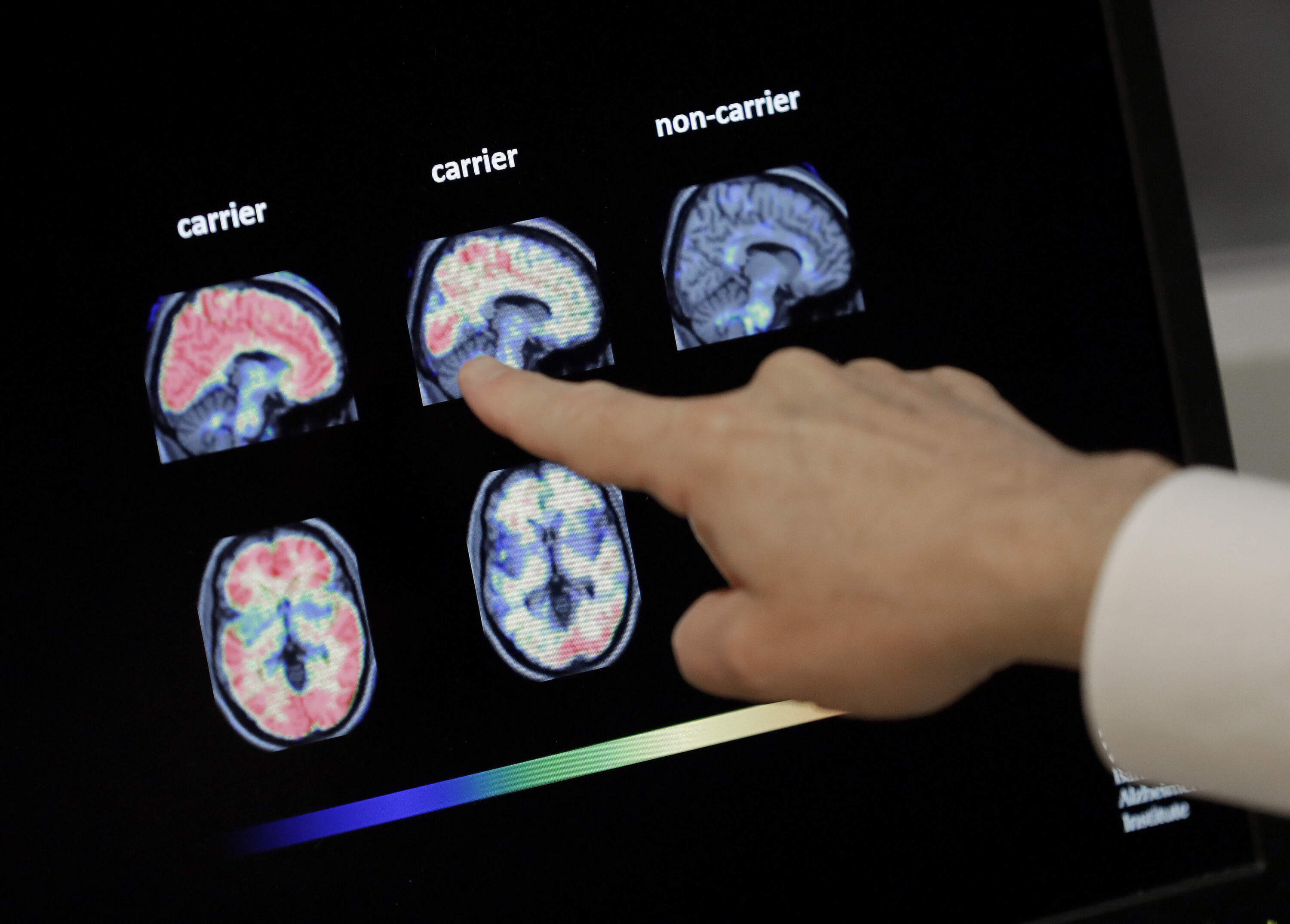 A doctor looks at PET brain scans at Banner Alzheimers Institute in Phoenix on Aug. 14, 2018. (Matt York/AP)